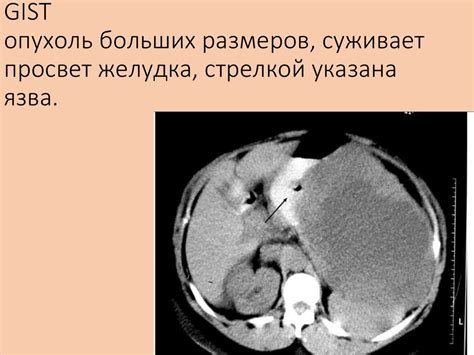 Неэпителиальные опухоли желудка - презентация онлайн