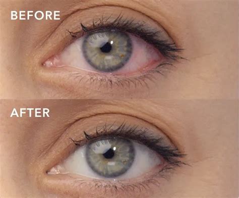 How LUMIFY® Redness Reliever Eye Drops Work Differently