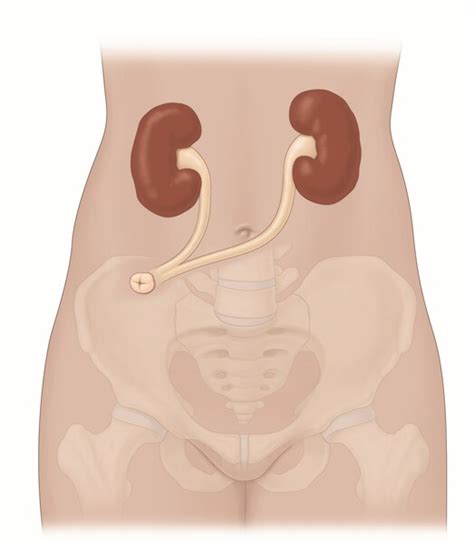 Cutaneous Ureterostomy - Unlabeled - Media Asset - NIDDK