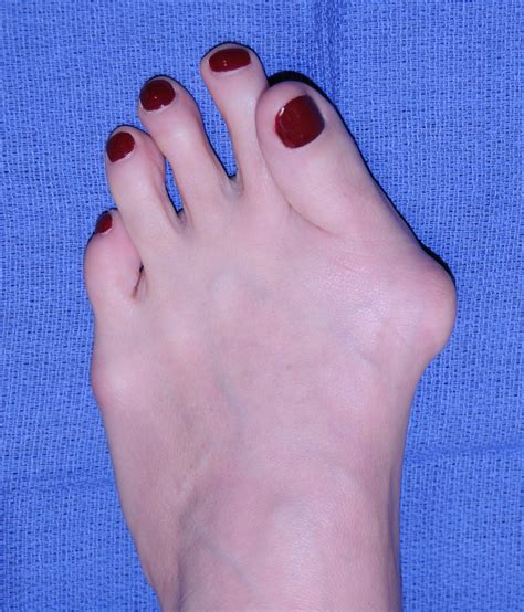 How To Prevent Bunions From Growing at Sherry Stamps blog