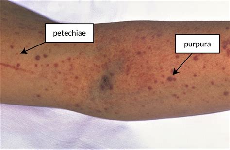 sangue  de purpura retoedu