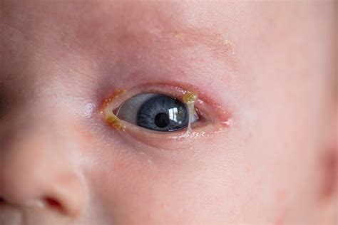 Gonococcal Conjunctivitis (Gonorrhea in the Eye)