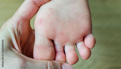 Enterovirus Feet Rash on the body of a child. Cocksackie virus rash ...