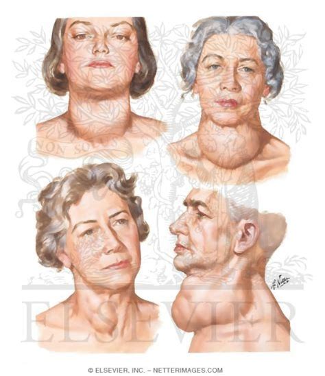 Goiter Definition Terminology Encyclopedia Resources Online