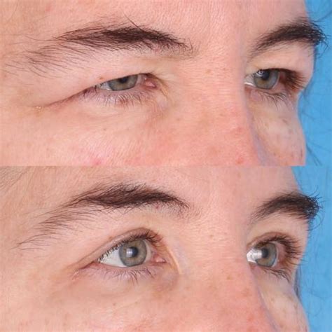 Best Upper Blepharoplasty Chicago, IL | Chicago Oculofacial Plastic Surgery