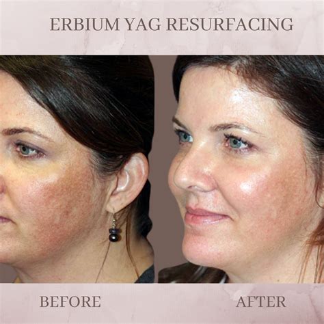 Erbium Yag Resurfacing - Eluma - Laser & Aesthetics