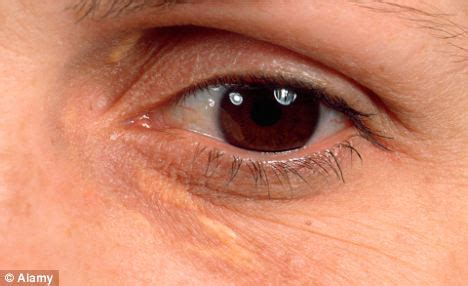 Eyelid Marks Sign of Potential Heart Attack