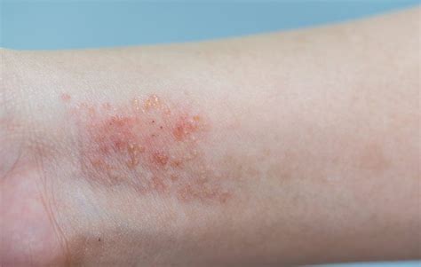 Ease Your Itchy Skin With These 8 Best Eczema Treatments | Prevention