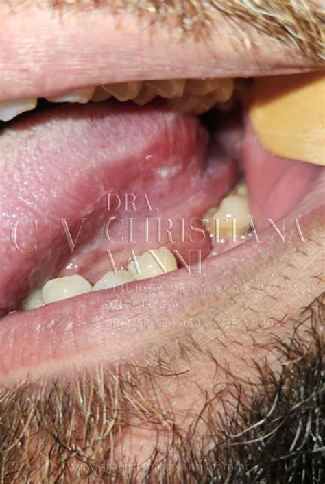 Cancer De Lingua Estagio Inicial - Cancer De Lingua Em Estagio Inicial Câncer De Boca Sintomas,
