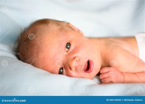 Infant Jaundice Eyes