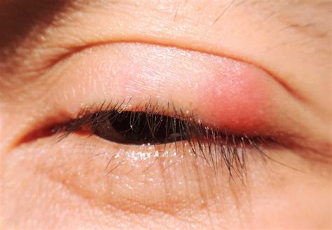 blefaritis posterior  es  tratamiento area oftalmologica avanzada
