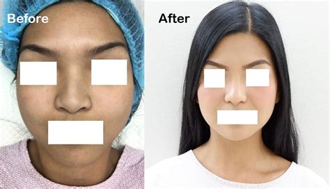 goal  nose surgery  rhinoplasty   improve  noses