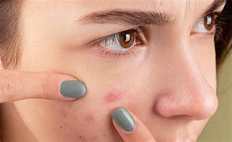 Acne Prone Skin | Know All About Acne Prone Skin at NDTV Food