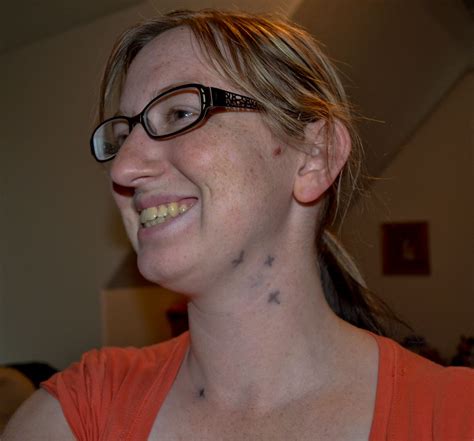 Swollen neck lymph nodes one side - euhety