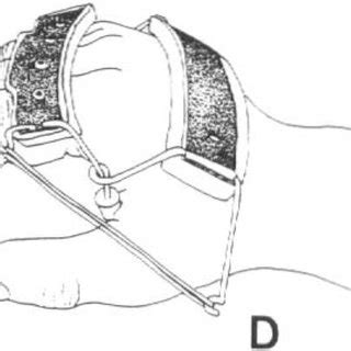 Tenodesis splints (TS). (A) Taping. (B) Heidleberg splint. (C) Volar... | Download Scientific ...