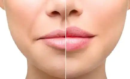 Lip Enhancement Augmentation Clinic in Bhubaneswar