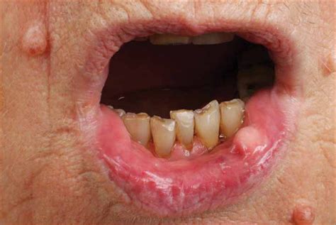 Mouth Cancer Symptoms Pictures Nhs England - Infoupdate.org