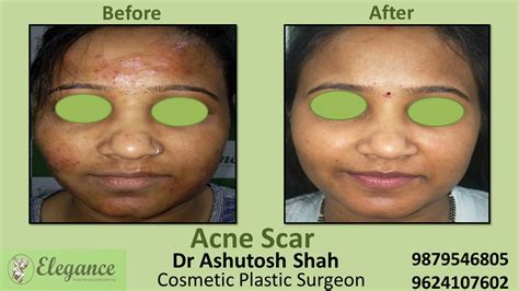 Acne Vulgaris Treatment in Navsari, Gujarat, India.