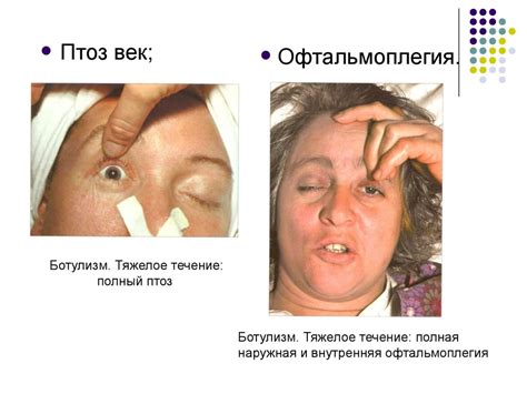 Ботулизм - презентация онлайн