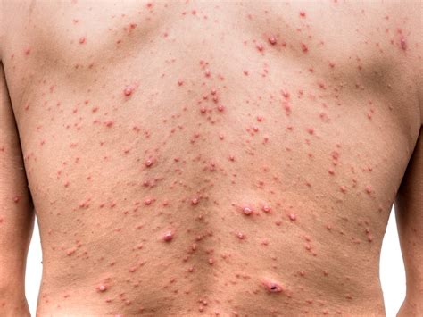 Chicken Pox Virus