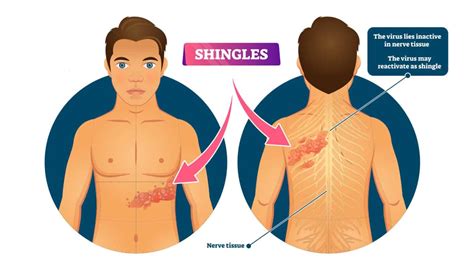 Head Shingles Nerve Pathways Diagram