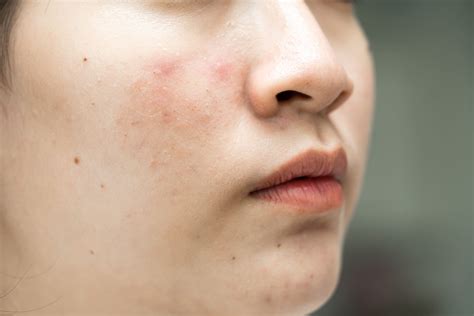 Facial Rashes: Causes, Symptoms & Treatment Options - Assurance Skin