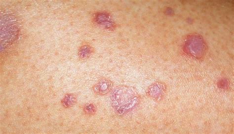 Diabetes Skin Rashes Pictures
