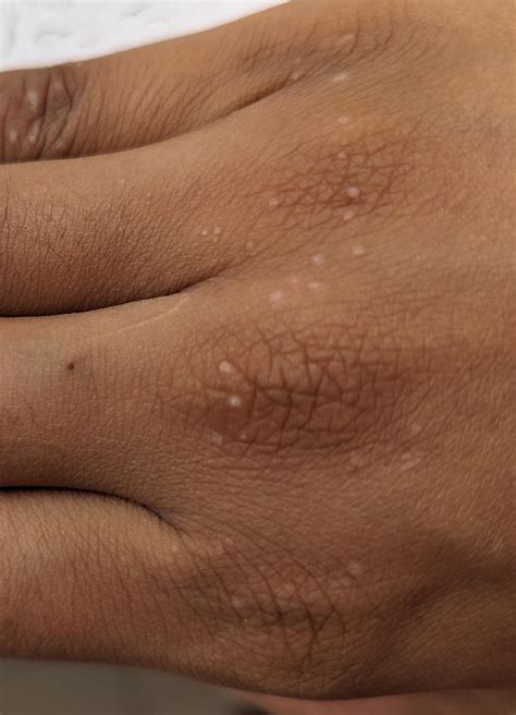 Very small tiny bumps on my hand : r/Dermatology