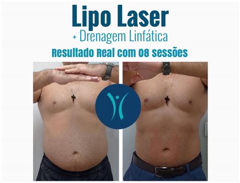 Lipo Laser, a Lipoaspiração sem dor. - InCorpore Estética Avançada ...