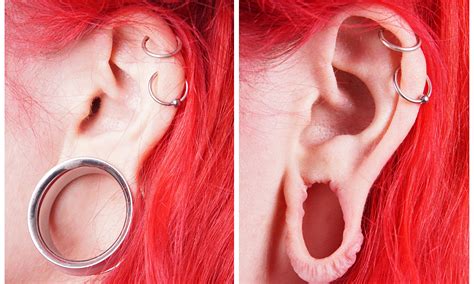 Earlobe Repair, Surgery for Stretched or Split Ear Lobes | Earlobes