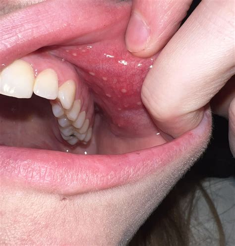 Canker Sore On Cheek Near Wisdom Tooth Wisdom Teeth Removal Explained