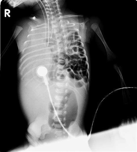 Diaphragmatic hernia - wikidoc