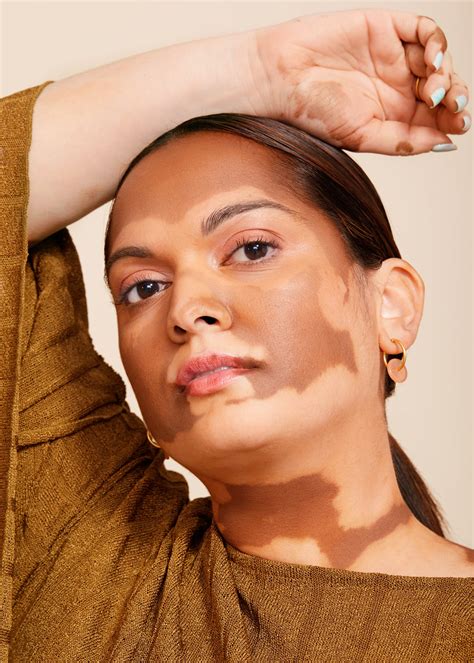 vitiligo skin condition   treatments popsugar beauty