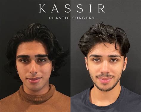 male celebrity rhinoplasty