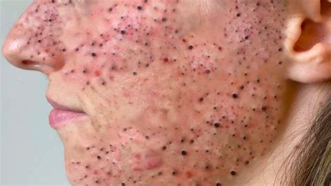 Experts Warn: This Unbelievable Blackhead Removal 2024 Trend is Dangerous! - b05hrhc