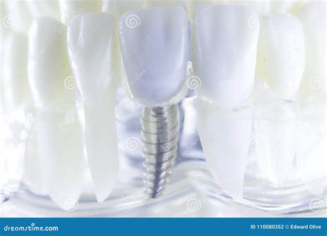 dental titanium tooth implant stock photo image  healthy metal