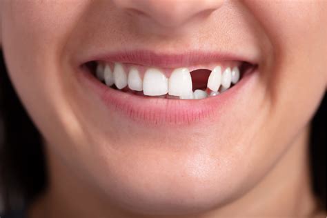 replace  missing teeth tooth replacement missing
