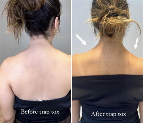 Traps Before And After at Barry Atchison blog
