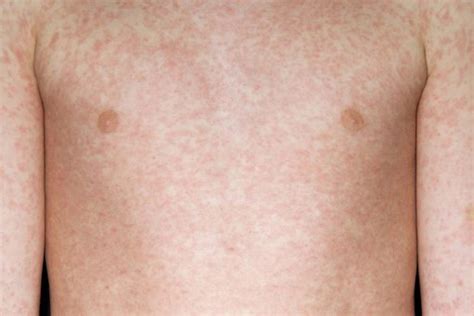 Measles - NHS