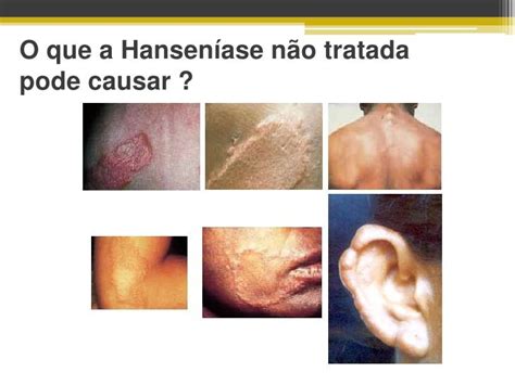 Como É A Mancha De Hanseniase - Hanseniase