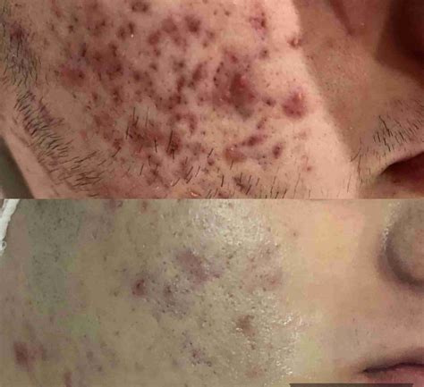 Doctors HATE This Unbelievable Blackhead Removal 2024 Technique! Image 11