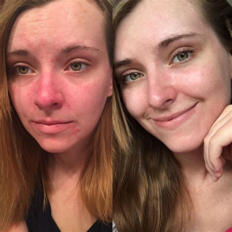 How To Get Rid Of Red Spots On Face From Dry Skin at Timothy Arrington blog