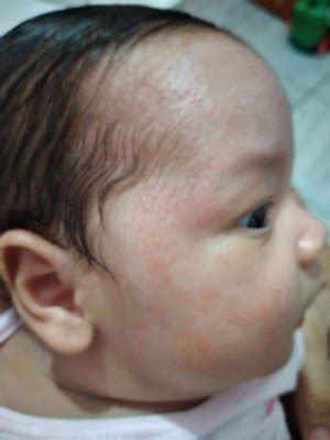Pele Do Bebê Grossa E Com Carocinhos - Carocinhos no rosto do bebê? | BabyCenter