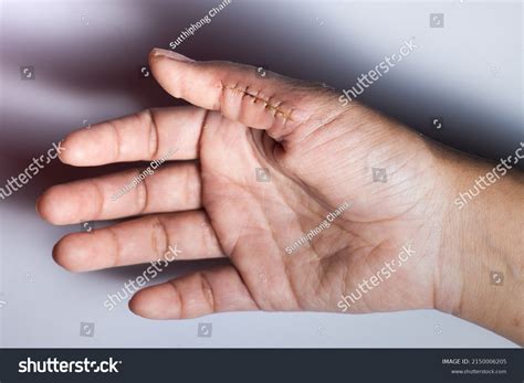 closeup hand wound stitches thumb wound stock photo