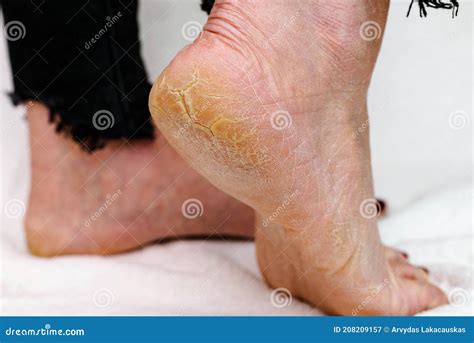 Dry and Cracked Soles of Feet. Womans Feet with Dry Heels, Cracked Skin ...