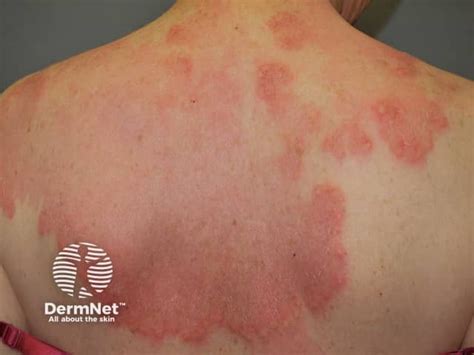 Granulomatous dermatitis