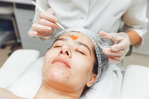 Chemical Peel - Dr Haach