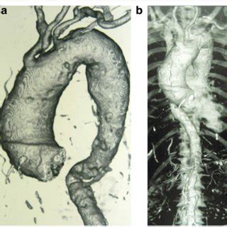 absence   origin  segmental branches  thoracic aorta