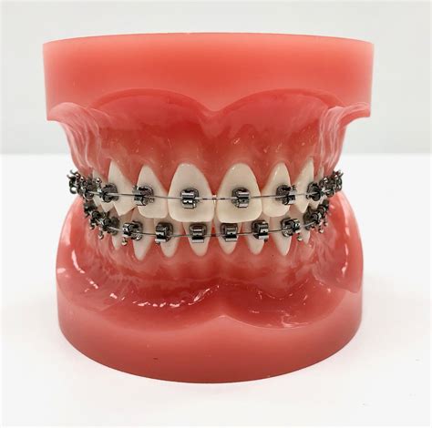 Vaste beugel / brackets (beugelcategorie 5,6) - Orthodontiepraktijk Den ...