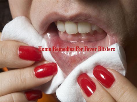 7 Home Remedies For Fever Blisters